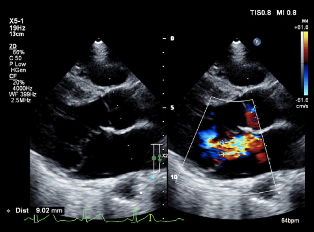 Mitral posterior leaflet prolapse and severe mitral valve regurgitation on echocardiography.