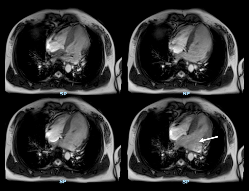 Severe mitral regurgitation on cardiac magnetic resonance imaging. Mitral regurgitation jet (arrow).