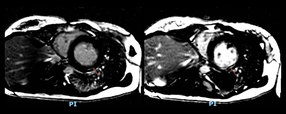 Late gadolinium enhancement increased in the subendocardial layer of the posterior wall suggested the existence of fibrotic tissue (red arrow).