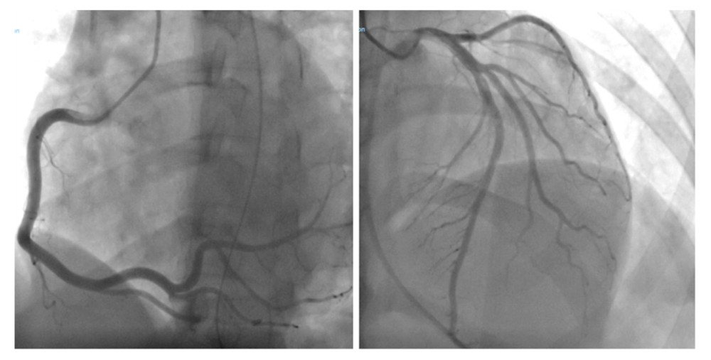 Angiogram shows non-obstructive coronary arteries.