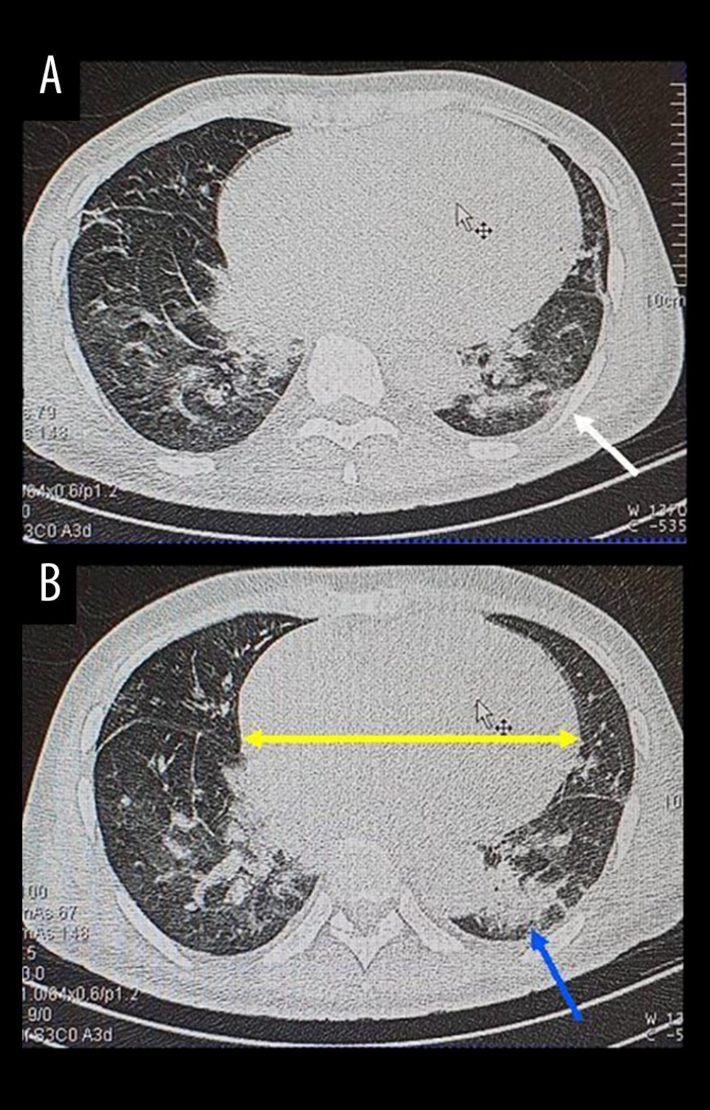Chest CT scan with extensive lung lesions of 50% to 55%. (A) Axial view in parenchymal window showing left basal subpleural consolidation (white arrow). (B) Axial slice showing nodular ground-glass opacities of the culmen with ventilatory disorders (blue arrow) and cardiomegaly (yellow arrow).