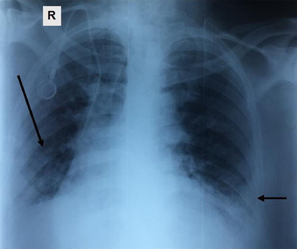 Chest X-ray showing non-systematized alveolar opacities predominating at both lung bases (black arrows). (R) – right lung.