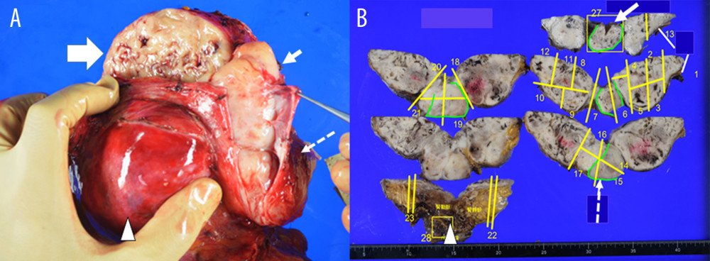 (A) Macroscopic findings of the primary inferior vena cava (IVC)-leiomyosarcoma (LMS) (thick arrows) by en bloc resection of the right kidney (arrowhead), adrenal (AD) gland and surrounding retroperitoneal soft tissue at the time of initial resection 4 years earlier [5]. The thin arrow indicates the tip of the LMS at the cut end of cranial-side IVC (dotted thin arrow). This image was not published in the previous report. (B) The transected formalin-embedded specimen. Green lines indicate the IVC wall with intraluminal filling by the LMS, which invaded the kidney and soft tissues.