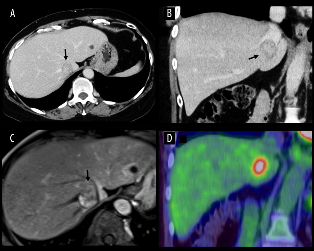 Image findings of tumor recurrence at 31 months after the first operation. (A) Axial and (B) coronal views of enhanced computed tomography images in the venous phase show a solitary, low-density, mass lesion 2.5 cm in size that was observed in the liver parenchyma adjacent to the right hepatic vein, middle hepatic vein, and the stump of the vena cava (black arrow). (C) Gadoxetate sodium-enhanced magnetic resonance image shows a partially hypervascular liver mass in the arterial phase (black arrow). (D) Positron emission tomography shows an accumulation of 18F-fluorodeoxyglucose in the tumor lesion.