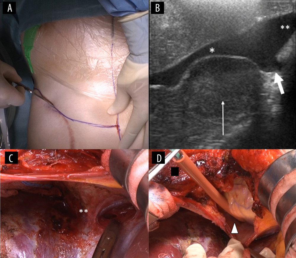 Reoperation for recurrent liver tumor was performed via (A) an upper median plus transverse incision. (B) Intraoperative ultrasonography showed the round mass (thin arrow) as a hypoechoic lesion compressing the right hepatic vein (*) and the area adjacent to the inferior vena cava (IVC) stump (thick arrow). The middle hepatic vein (**) was not compressed by the tumor. (C) The confluence of the MHV was isolated, but dissection around the RHV and the front of the IVC was difficult due to tumor compression. (D) To control injury to the IVC, the IVC in the pericardium was encircled by a tourniquet (arrowhead) before hepatectomy.