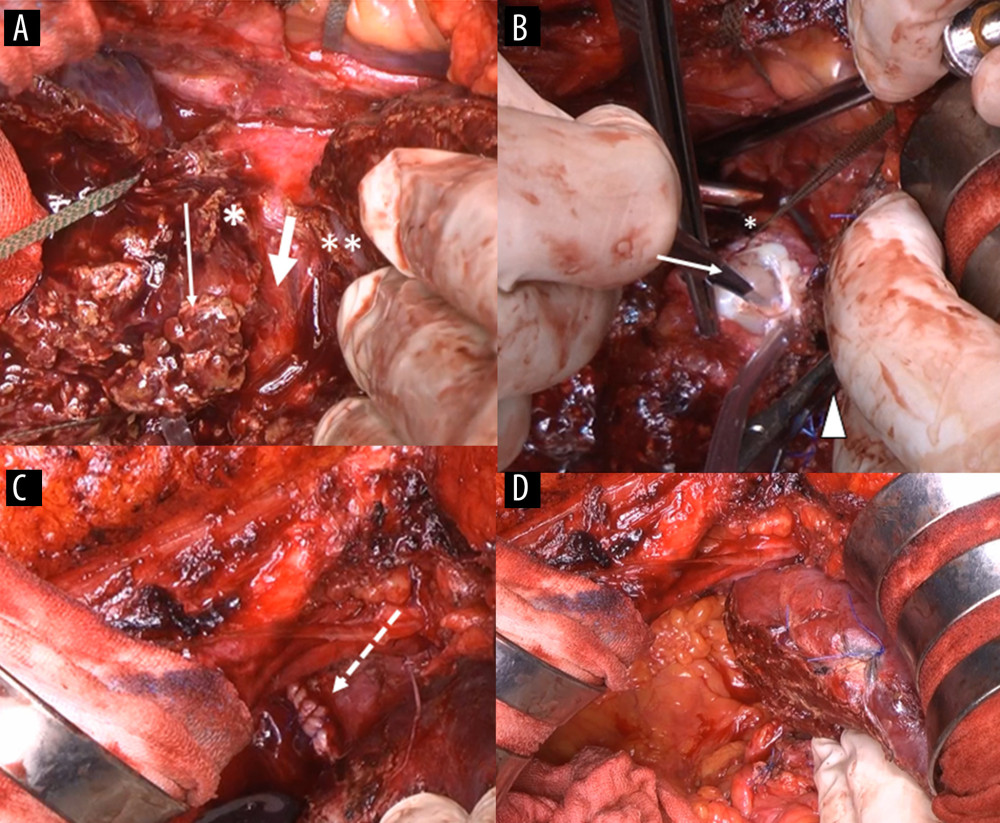 Findings of hepatic transection. (A) The liver tumor (thin arrow) was infiltrating the confluence of the RHV (*) and IVC stump (thick arrow). The MHV (**) was secured. (B) Side clamping of the IVC (arrowhead) by vascular forceps allowed the vena cava wall to be transected. (C) The transected stump was sutured (dotted arrow), and (D) the right hepatectomy was completed.