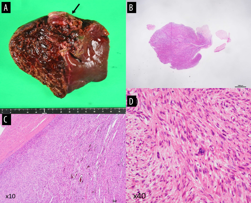 Macroscopic (A) and microscopic findings of the tumor of the intrahepatic mass lesion (black arrow). (B) Histological findings of hematoxylin and eosin staining by objective magnification: (B) ×4, (C) ×10 and (D) ×40. Intravenous infiltration can be observed by elastic fiber staining in C and D. Spindle cell-like leiomyosarcoma cells proliferated within a network structure.