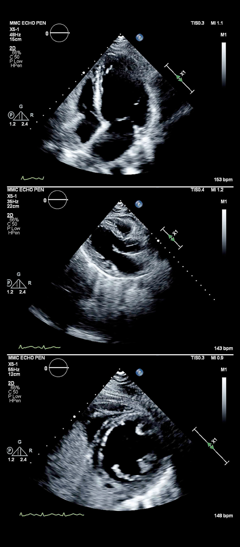 Representative images from the transthoracic echocardiogram on hospital day 2, which showed a dilated left ventricle with a reduced ejection fraction. Top to bottom: apical 4 view, parasternal long axis view, and parasternal short axis view.