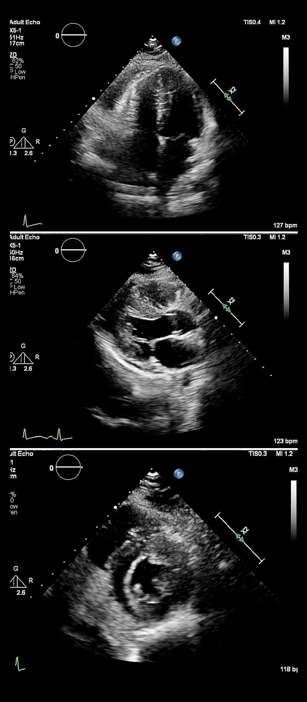 Representative images from the repeat transthoracic echocardiogram on hospital day 20, which showed resolution of the left ventricular dilation and normal ejection fraction. Top to bottom: apical 4 view, parasternal long axis view, and parasternal short axis view.
