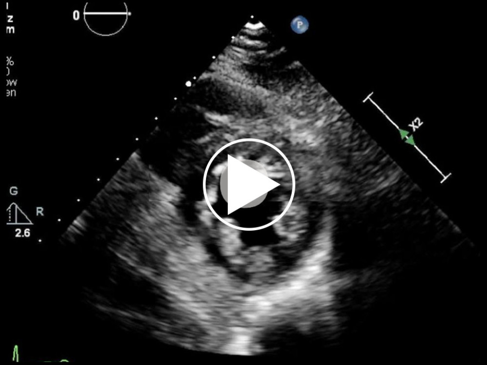 Video clip of the transthoracic echocardiogram on hospital day 20, which shows resolution of the left ventricular dilation and normal ejection fraction. Views in order of appearance: parasternal long axis view, and parasternal short axis view, apical 4 view.