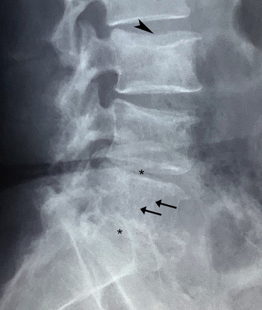 Lumbar radiograph, lateral view. A close-up of the lower lumbar segments shows coarse, thickened vertical trabeculae evident at the L5 vertebral body (arrows), suggestive of a vertebral hemangioma. While the outside radiology report suggested a hemangioma at L4 as well, our secondary review was not concordant with this determination, as the sclerosis in L4 appeared more heterogeneous. Also, while not noted in the original report, the superior endplate of L3 was noted to be slightly concave (arrowhead), compatible with a possible occult vertebral fracture. Disc space narrowing was also apparent at L4–5 and L5-S1 (*). Due to the original images being taken on plain film, there was a loss of quality when copying these into the patient’s file.