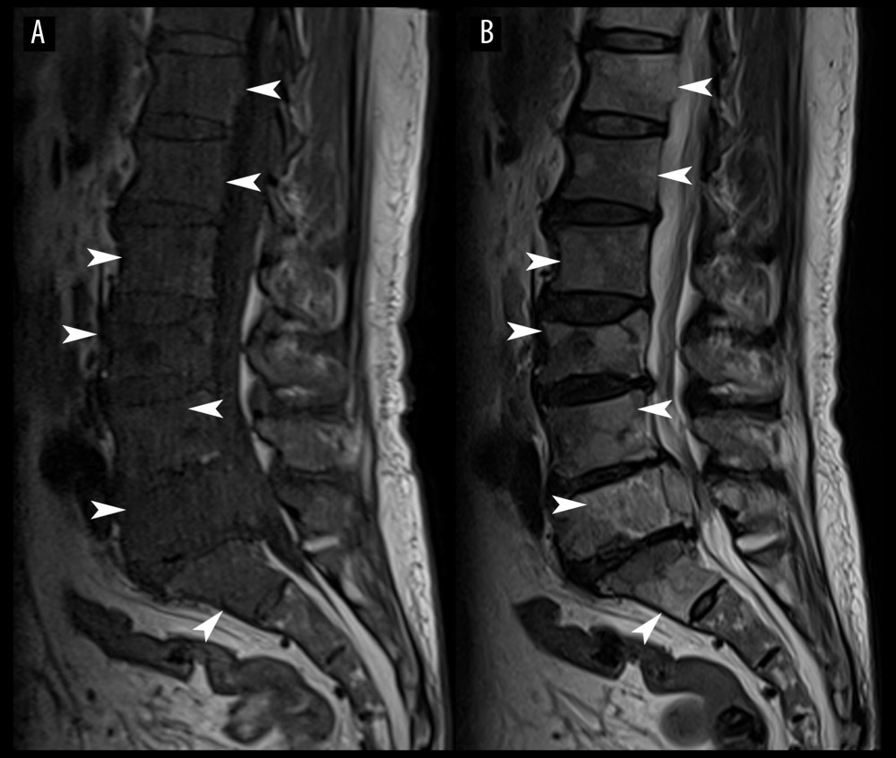 Lumbar magnetic resonance imaging, mid-sagittal T1-weighted (A) and T2-weighted images (B). Diffuse bone marrow replacement evident as T1-weighted hypointense and heterogeneous T2-weighted hyperintense signal is seen throughout the axial spine and sacrum, suggestive of bone metastases (arrowheads).