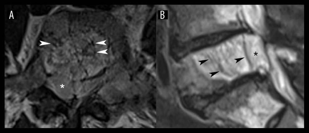 Lumbar magnetic resonance imaging features of the L5 vertebra. Thickened vertical bone trabeculae (arrowheads) are apparent as small hypointense areas in a salt-and-pepper pattern in the axial T1-weighted image (A) and as vertical hypointense striations in the sagittal T2-weighted image (B), which are both typical imaging findings of a vertebral hemangioma. Also noted is the epidural extension of the tumor (*; images A and B), which causes severe spinal stenosis and cauda equina compression and is more suggestive of malignancy.