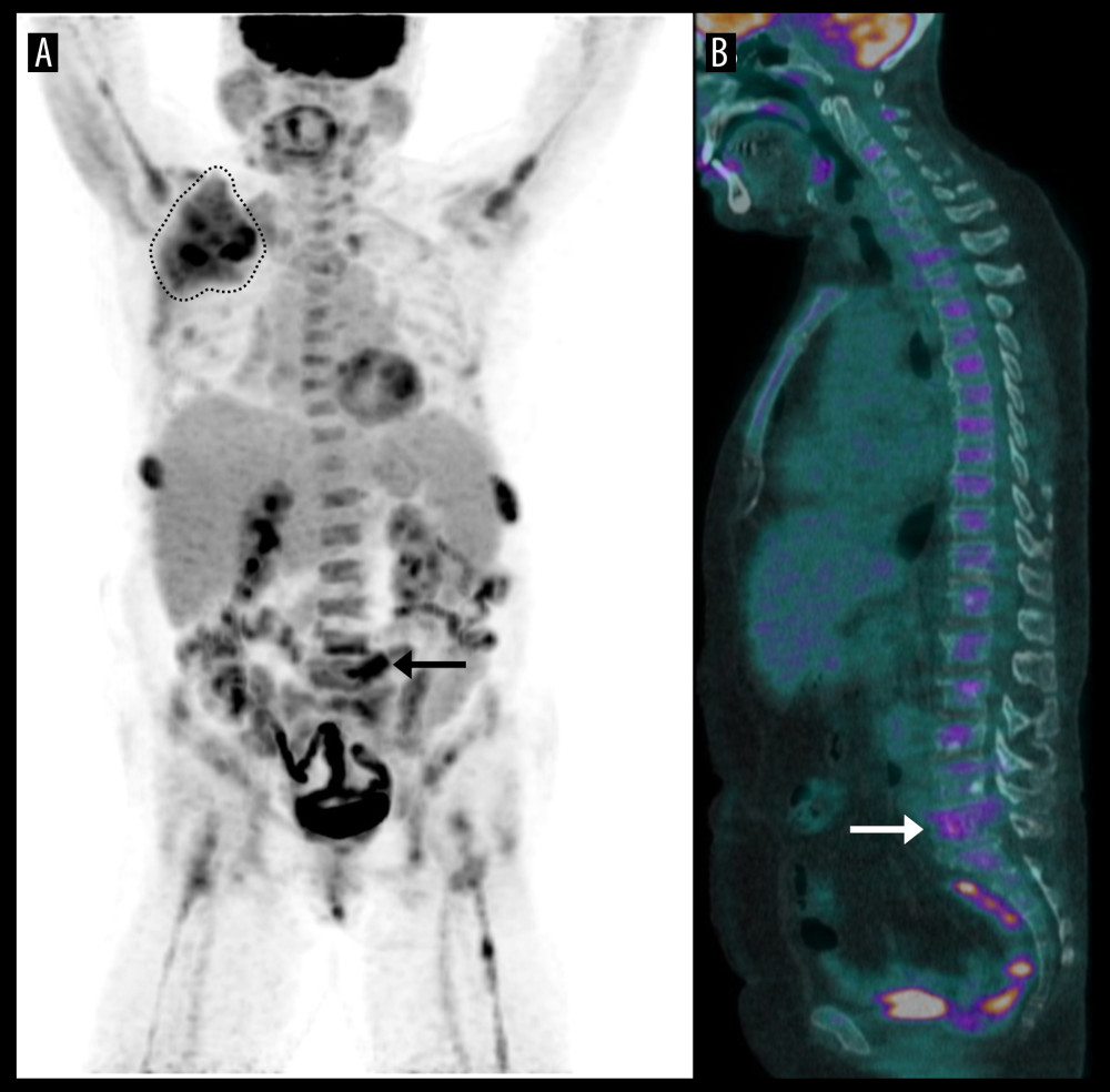 F18 Fluorodeoxyglucose (FDG) whole body positron emission tomography/computed tomography (PET/CT) excluding brain. Fused coronal PET/CT (A) showing large hypermetabolic right axillary lymphadenopathies extending from level I to level III (region enclosed by dotted line, 8.86×4.00×10.45 cm, maximum standard uptake value [SUV] of 9.28), suggestive of lymph node metastases, as well as increased uptake at L5 (arrow). Diffuse hypermetabolic lesions in the axial skeleton are also noted in the sagittal fused PET/CT (B), which is most evident at L5 (arrow) with a maximum SUV of 6.94, the highest value of any structure or vertebra. Physiologic FDG uptake is also noted in the limited brain regions, salivary glands, oropharynx, ocular muscles, vocal cords, liver, spleen, and bowel.