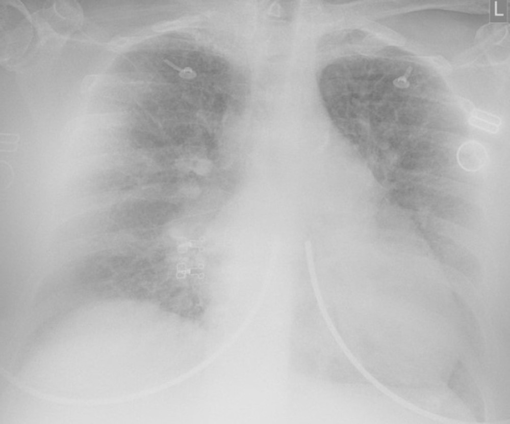 Erect anterior-posterior chest radiograph performed on admission, displaying prominent bilateral lung hila and widespread interstitial markings, but no consolidation.