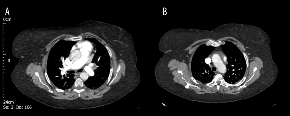 Axial slices of the computed tomography pulmonary angiogram (CTPA) in the arterial phase showing (A) no evidence of significant pulmonary embolism in the main pulmonary artery or the lobar, segmental, and subsegmental branches of the pulmonary tree; and (B) full vascularization of the right upper lobe.