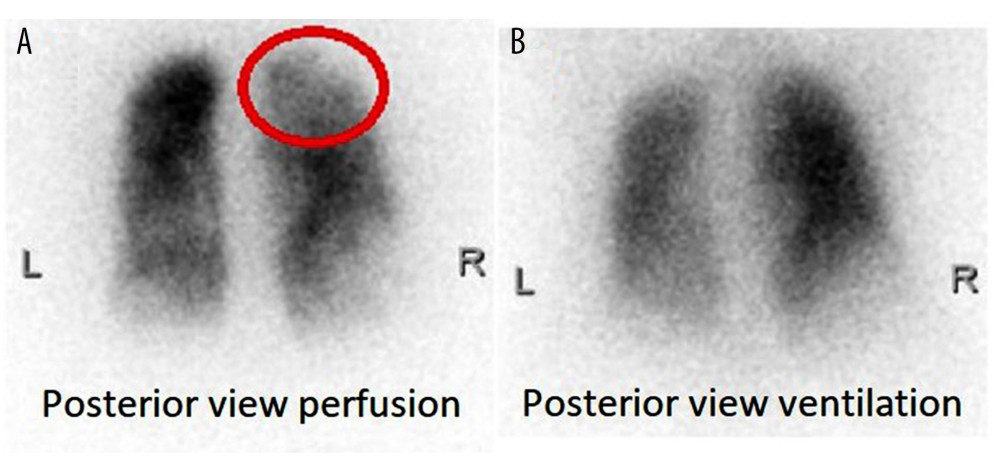 Ventilation/Perfusion (V/Q) scan in the posterior view displaying (A) perfusion and (B) ventilation phases. The perfusion mismatch at the right lung apex is circled in red. L and R indicate the left and right lungs, respectively.