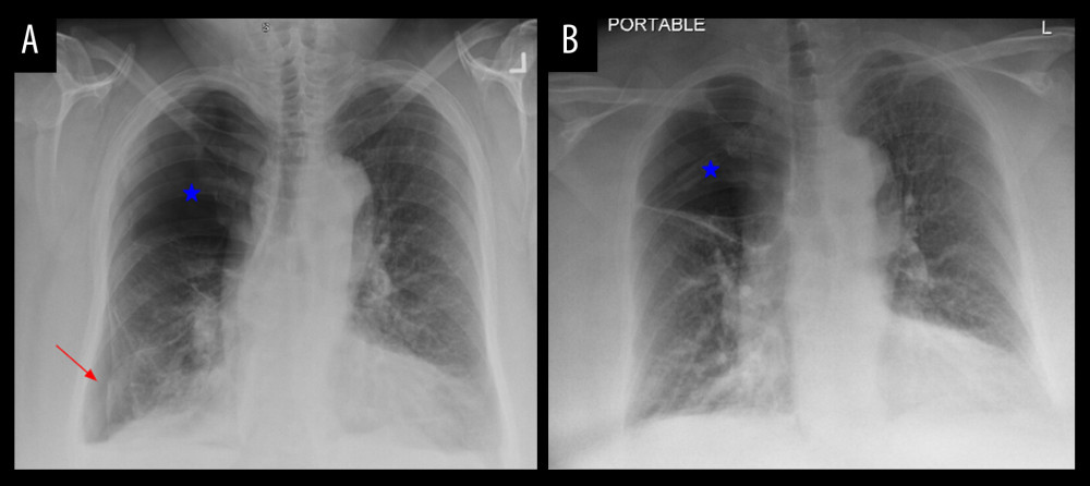 Chest radiography of (A) previous admission and (B) day 1 of the current admission. Extensive bullous disease of the right upper lobe is seen in both images (blue star), and is associated with a new-onset small right-sided pneumothorax (red arrow in image B).