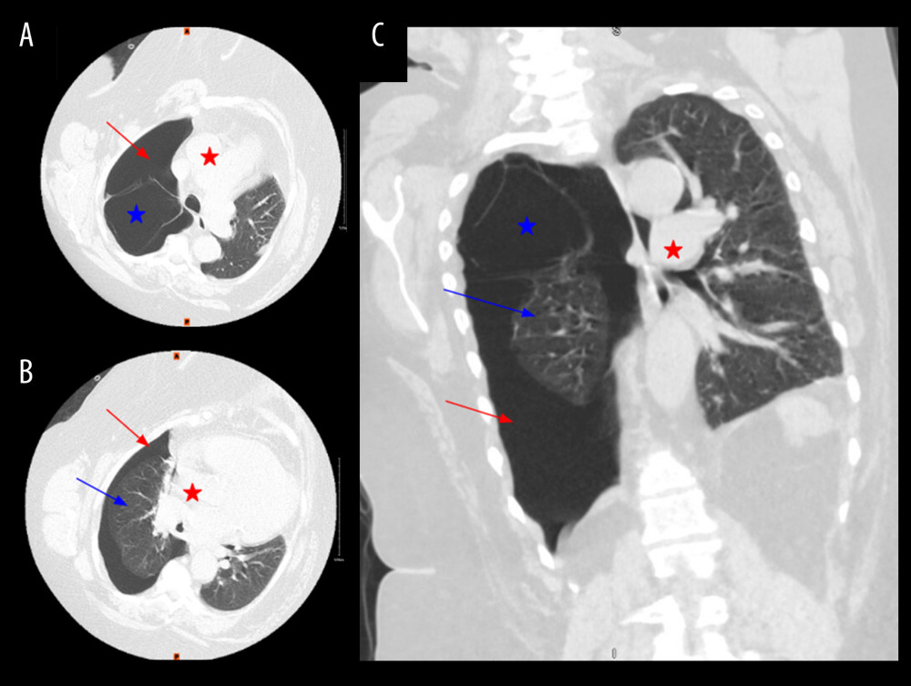 High resolution computer tomography (HRCT) with (A, B) axial and (C) coronal views on day 3, showing a large right-sided pneumothorax (red arrow) and a large bulla at the superior segment of the right upper lobe (blue star), with total collapse of the right middle and the right lower lobes (blue arrow). There is a right to left mediastinal shift (red star).