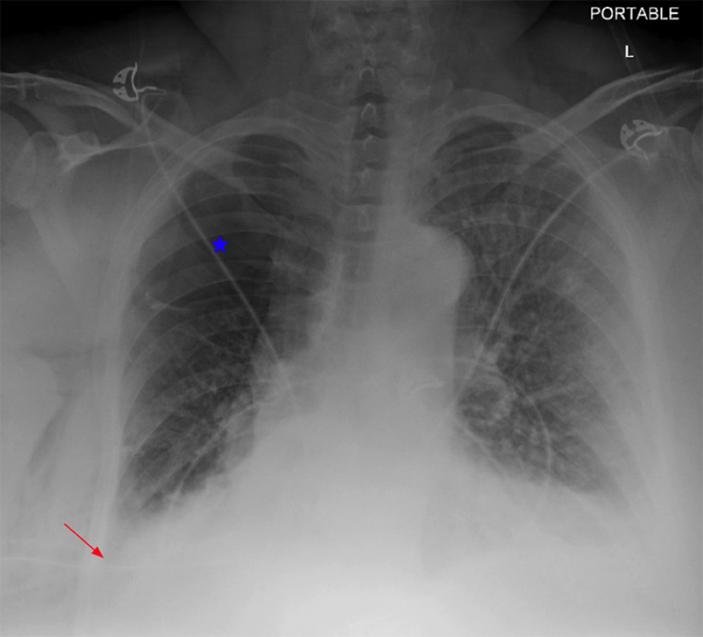 Chest radiography on day 3 showing bullous disease of the right upper lobe (blue star) and complete right-sided pneumothorax, with the chest tube in place (red arrow)