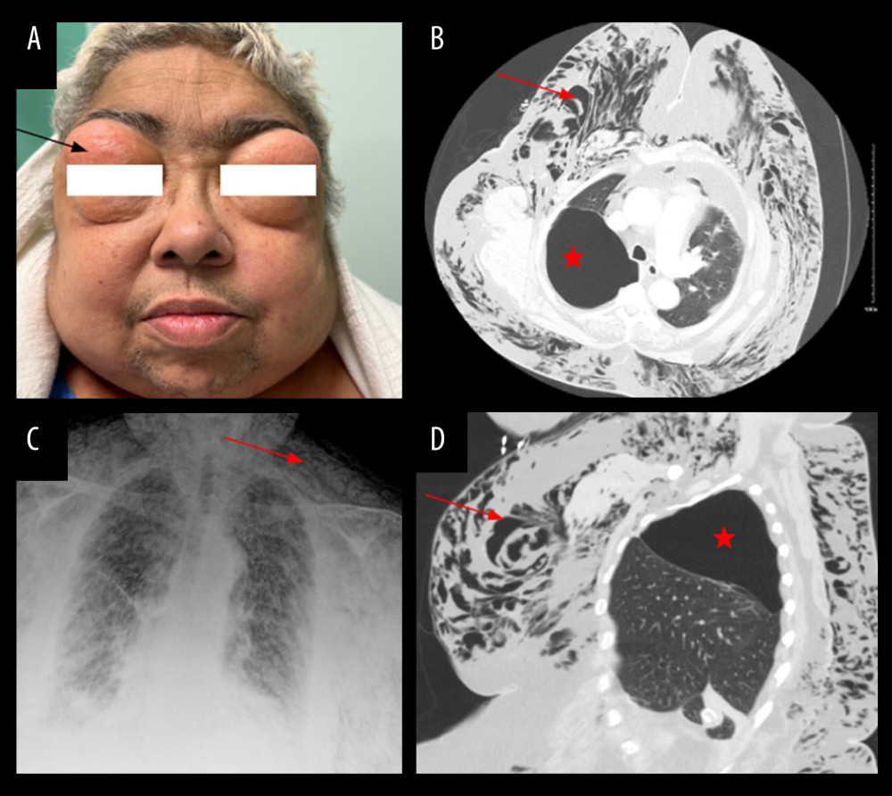 (A) Massive subcutaneous emphysema was found on physical examination, with eyelid swelling on day 4 (black arrow). (B) Chest radiography demonstrated diffuse subcutaneous emphysema (red arrow). (C, D) Axial and sagittal views on computed tomography scan showing a large bulla in the right upper lung lobe (red arrow) and a large bulla (red star).