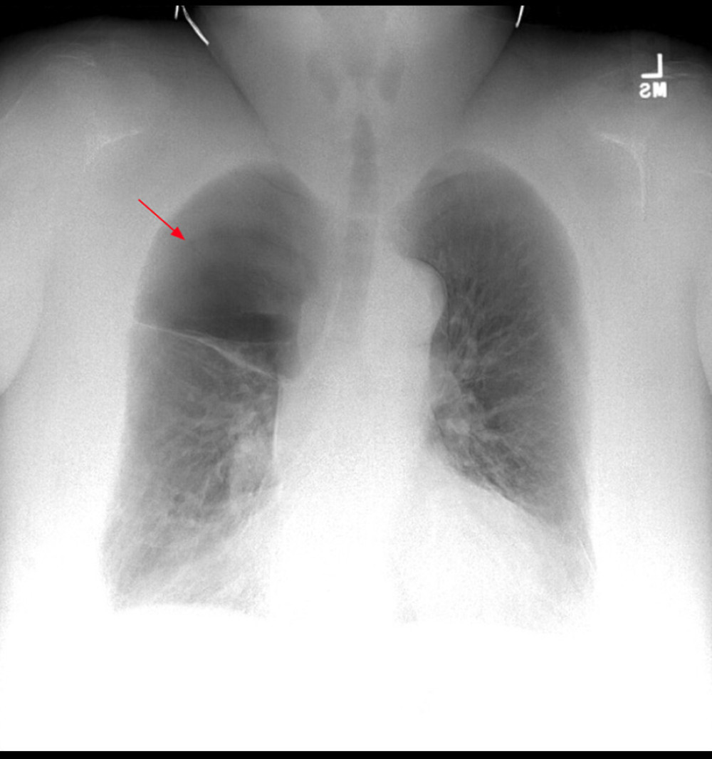 Day 15, chest radiography showing complete resolution of the subcutaneous emphysema and pneumothorax, with stable large blebs in the right upper lobe of the lung (red arrow).