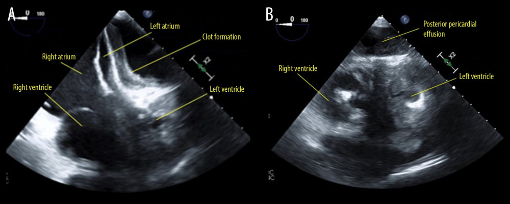 (A) Midesophageal four-chamber view and (B) transgastric mid-papillary short-axis view of near-complete collapse of the left atrium and left ventricle with preservation of the right heart chamber sizes in the setting of a large heterogenous posterior pericardial effusion in a patient with left ventricular assist device.