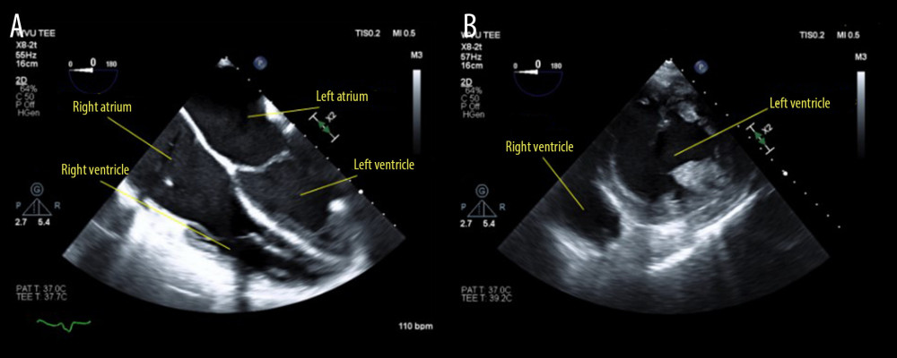 (A) Midesophageal four-chamber view and (B) transgastric mid-papillary short-axis view after surgical evacuation of a large heterogenous posterior pericardial effusion in a patient with left ventricular assist device.