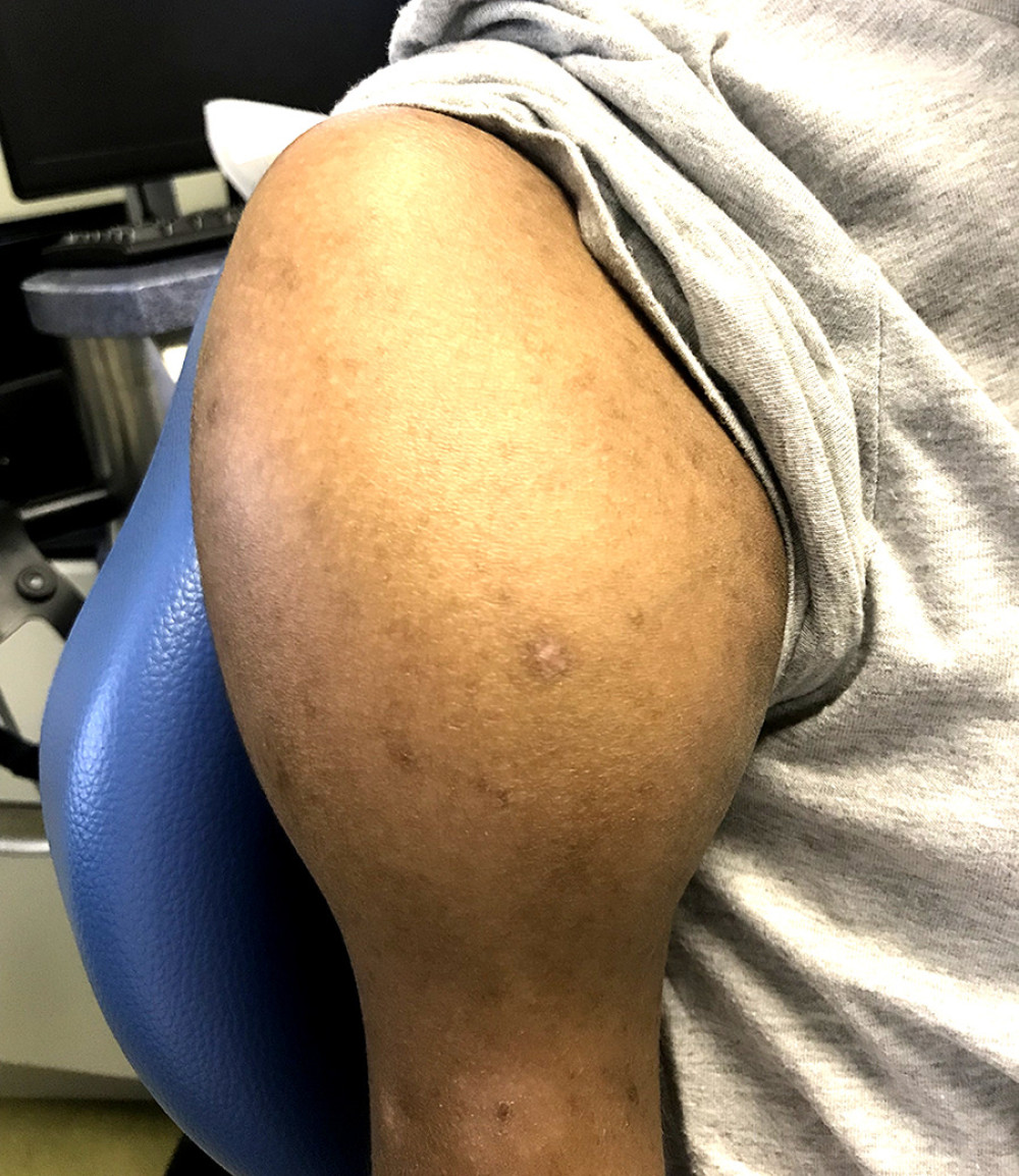 Clinical photo of the swollen right shoulder.