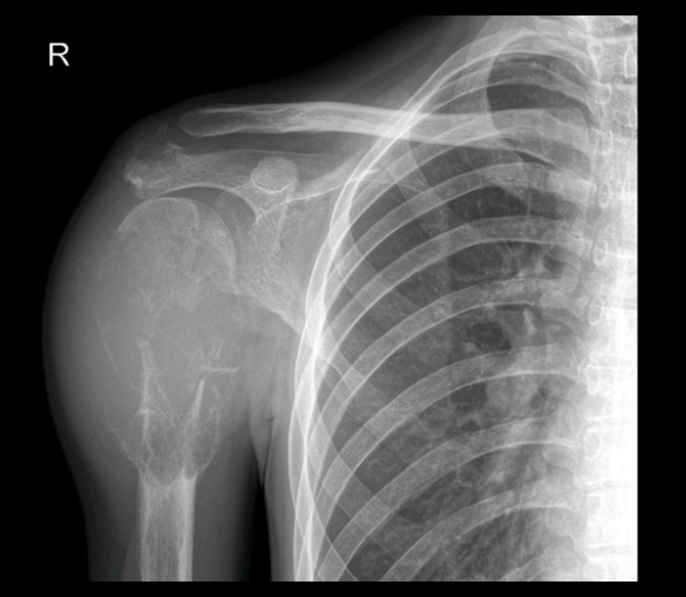 A plain chest X-ray image showing soft-tissue swelling of the right shoulder.