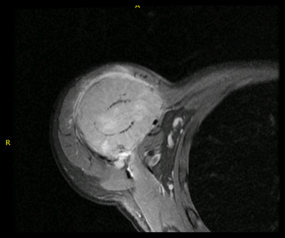Magnetic resonance imaging of the shoulder shows a soft-tissue lesion, which is iso-intense relative to the muscle and shows enhancement in the right humoral head; the lesion extends to the right glenu-humoral head.