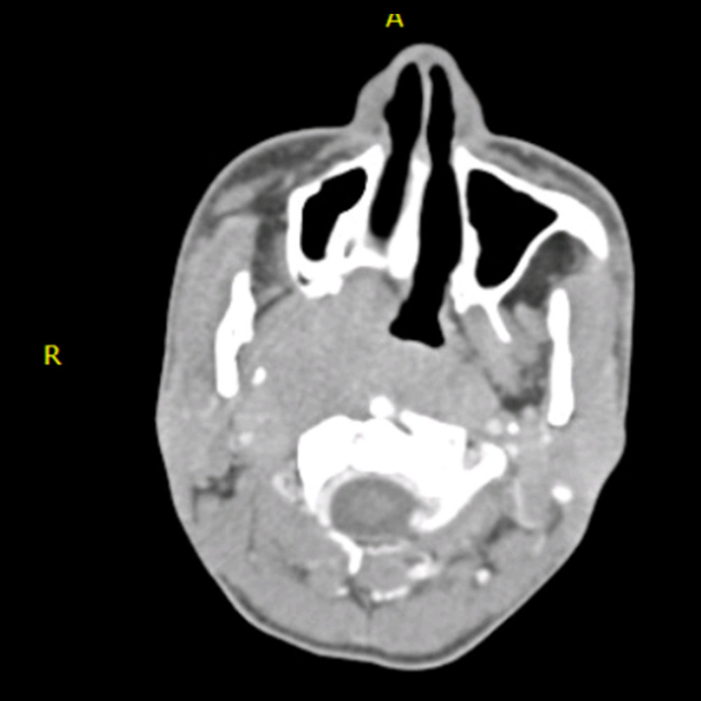 A computed topography image with a contrast axial view shows a large RT nasopharyngeal mass extending to the RT pterygoid muscle with erosion in the medial pterygoid process. The lesion further extends to the prevertebral space posteriorly (arrow).