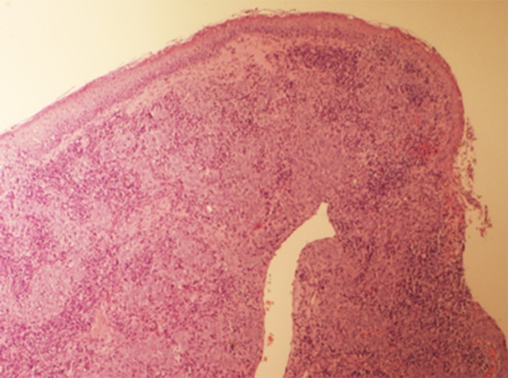 Low-power magnification (3×) of a hematoxylin and eosin stain shows a growing mass under the epithelial lining.