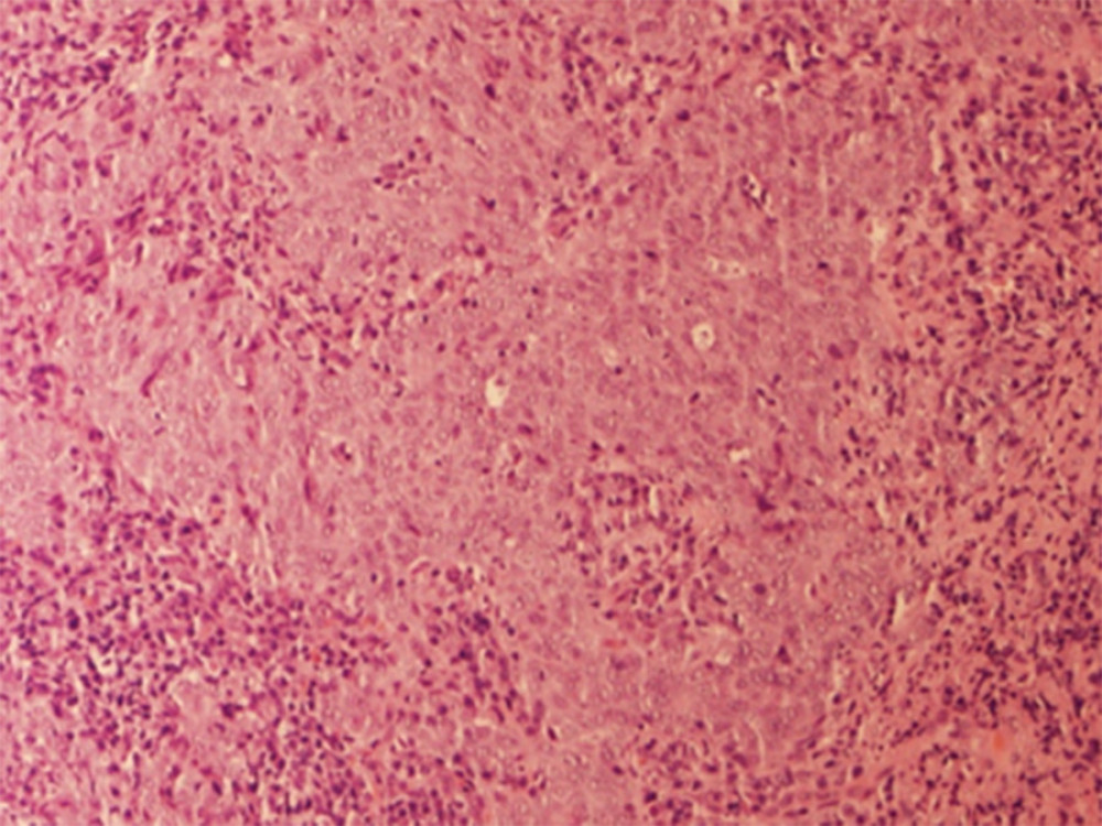 High-power magnification of hematoxylin and eosin stain reveals a sheet of cells with pleomorphism, a high nuclear-to-cytoplasmic ratio, and prominent nucleoli.