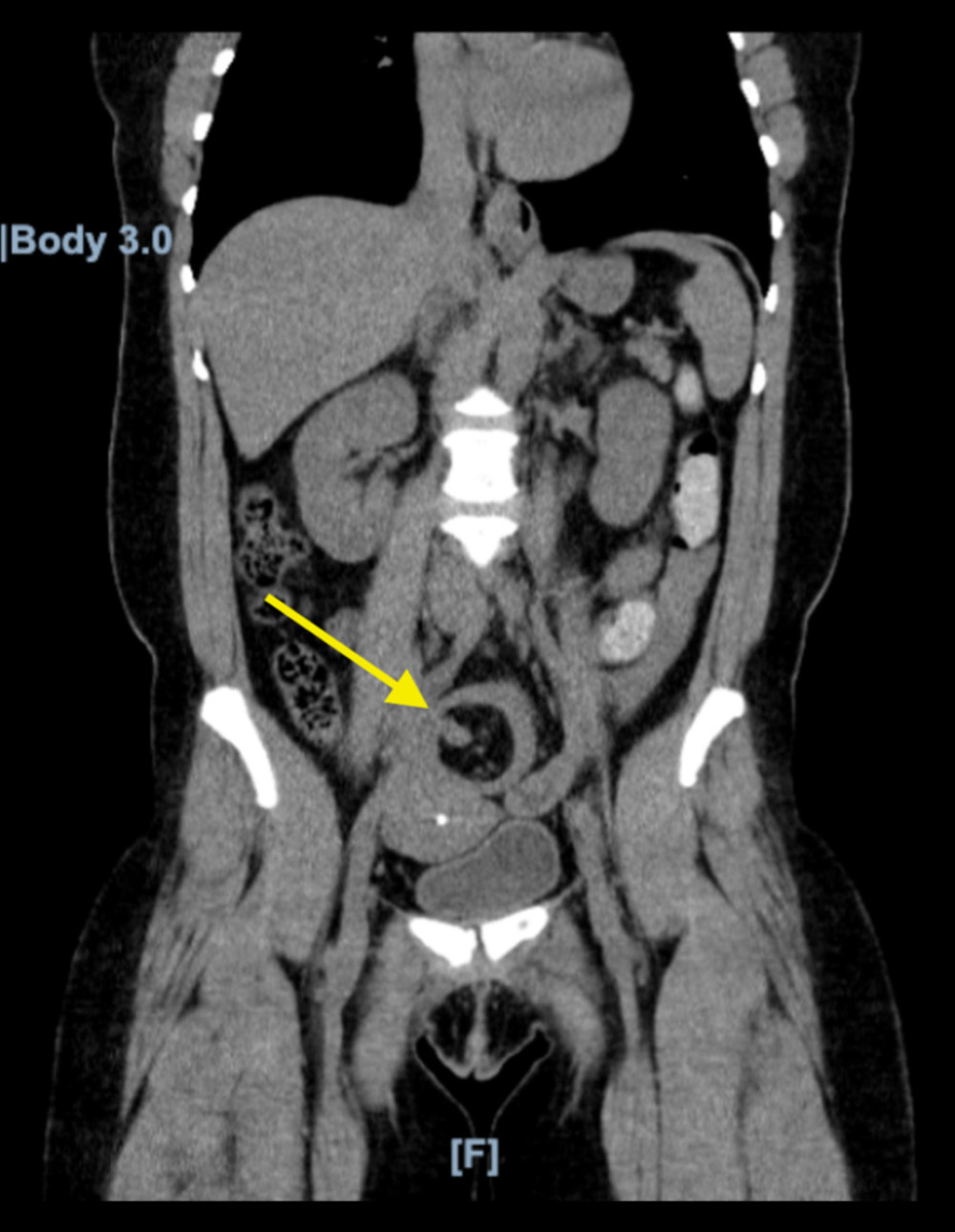 Computed tomography of the abdomen and pelvis without contrast showing an arrow pointing to the region of colo-colonic intussusception.