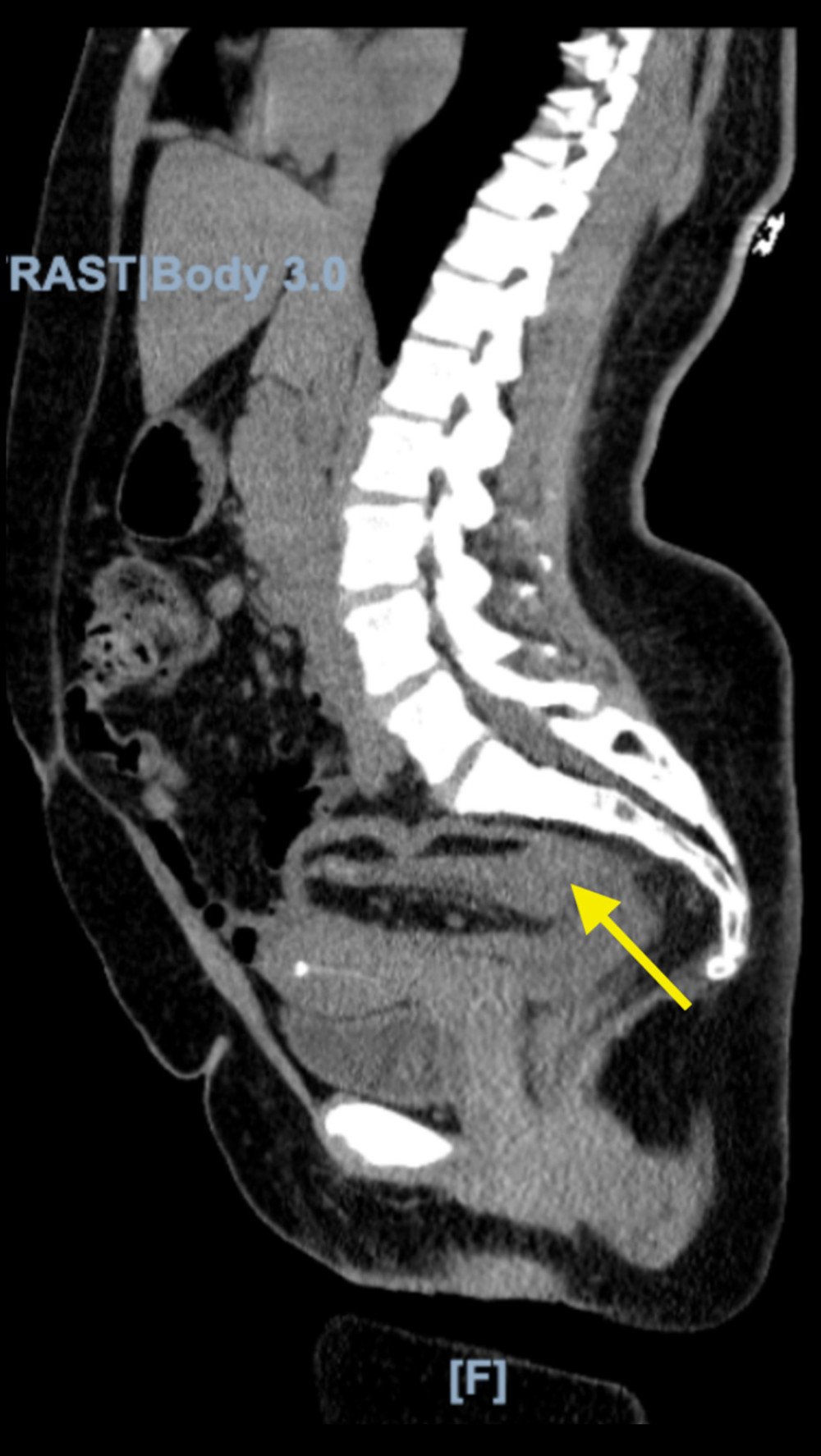 Computed tomography of the abdomen and pelvis without contrast showing an arrow pointing to the region of colo-colonic intussusception.