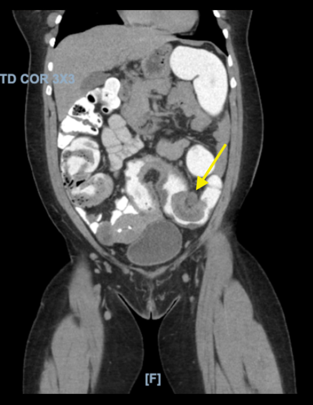 Computed tomography of the abdomen and pelvis with intravenous, oral, and rectal contrast showing reduction of intussusception and an arrow pointing to the intra-luminal mass within the sigmoid colon.