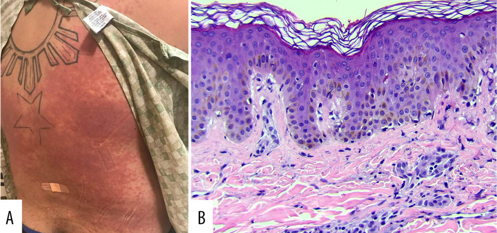 The patient’s exanthematous rash upon presentation. (A) Maculopapular rash of the trunk and extremities, which spared the palms, soles, and mucosa. (B) A punch biopsy from the patient’s back with hematoxylin and eosin staining at 200× zoom, showing nonspecific basketweave orthokeratosis, mild spongiosis, basal vacuolar change/interface dermatitis, and a superficial perivascular lymphocytic infiltrate without eosinophils.