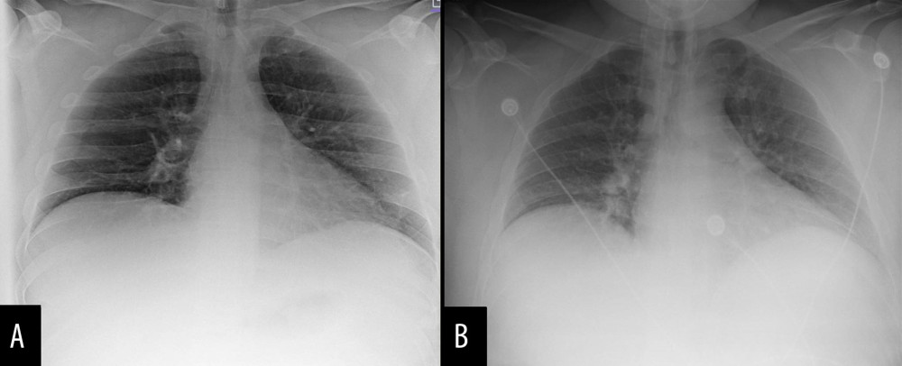 Chest X-rays in anteroposterior view showing rapid pulmonary decompensation. (A) The initial chest X-ray taken at the time of admission, showing hypoventilatory changes with mild central airway thickening, likely accentuated by poor breath-hold. No lobar consolidation. (B) Chest X-ray on hospital day 1 due to respiratory distress, showing central bronchial wall thickening, which would correlate with airway diseases such as asthma or bronchitis. There is no confluent consolidation and persistently low lung volumes.