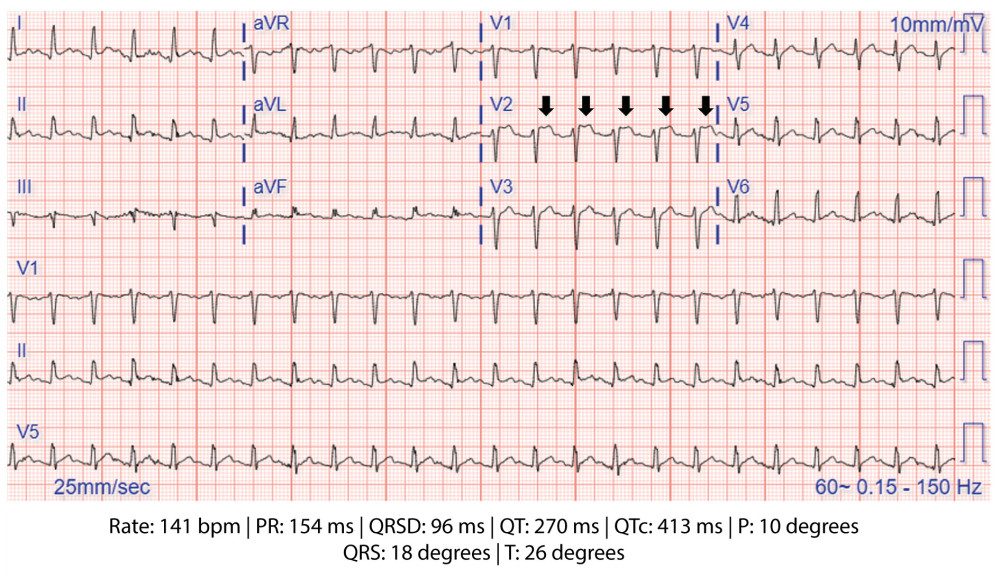 An electrocardiogram (ECG) that was obtained due to prolonged tachycardia. The cardiologist’s interpretation of this ECG revealed sinus tachycardia with anterior lead ST-elevation (arrows) in lead V2. ST-elevation myocardial infarction (STEMI) was doubtful but could not be ruled out with consideration for pericarditis.