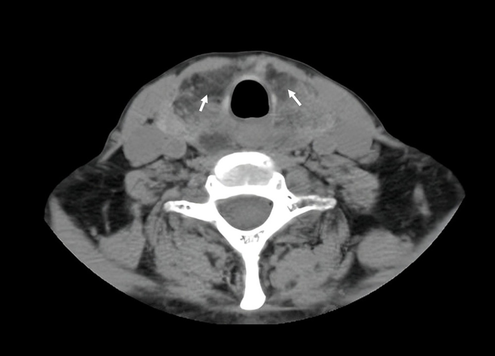 Computed tomography of the neck without contrast. CT scan showing diffuse goiter with hypodense areas (white arrows).