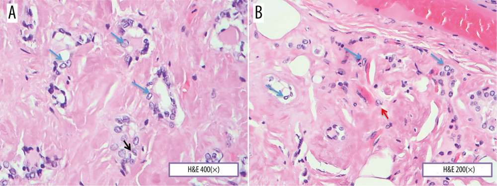 (A, B) A photomicrograph of the thyroid gland showing papillary carcinoma and amyloid deposition. The thyroid gland is infiltrated by pleomorphic malignant cells with nuclear enlargement and “ground-glass” nuclei (blue arrows), nuclear grooves (black arrow), and nuclear pseudo-inclusions (red arrow). The normal background thyroid tissue is replaced by amorphous pink material with the typical appearance of amyloid. Hematoxylin and eosin stain (H&E). Objective magnification A ×400 and B ×200.