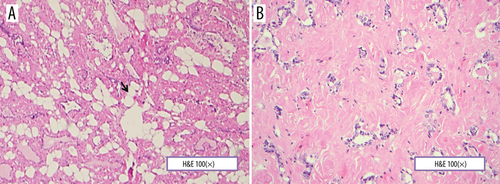 (A, B) A photomicrograph of the histopathology of the thyroid gland showing lipomatosis. The thyroid gland contains mature adipose tissue without inflammation or nuclear atypia (black arrow). The normal background thyroid tissue is replaced by amorphous pink material with the typical appearance of amyloid. Hematoxylin and eosin (H&E). Objective magnification ×100.