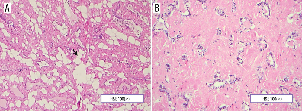 (A, B) A photomicrograph of the histopathology of the thyroid gland showing lipomatosis. The thyroid gland contains mature adipose tissue without inflammation or nuclear atypia (black arrow). The normal background thyroid tissue is replaced by amorphous pink material with the typical appearance of amyloid. Hematoxylin and eosin (H&E). Objective magnification ×100.