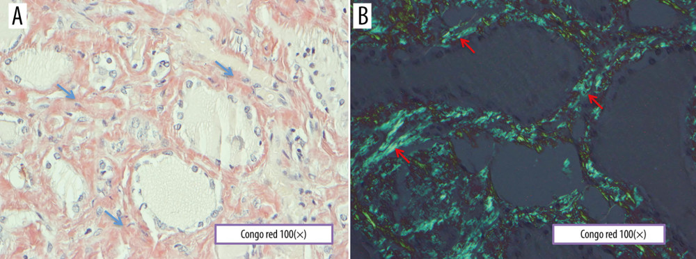 A photomicrograph of the light microscopy and polarized light microscopy of the thyroid gland showing amyloid (A) Light microscopy of the Congo red histochemical staining shows areas of amyloid (blue arrows). Congo red. Objective magnification ×100. (B) Polarized light microscopy of the Congo red staining shows apple-green birefringence in polarized light (red arrows), which is typical for amyloid. Objective magnification ×100.