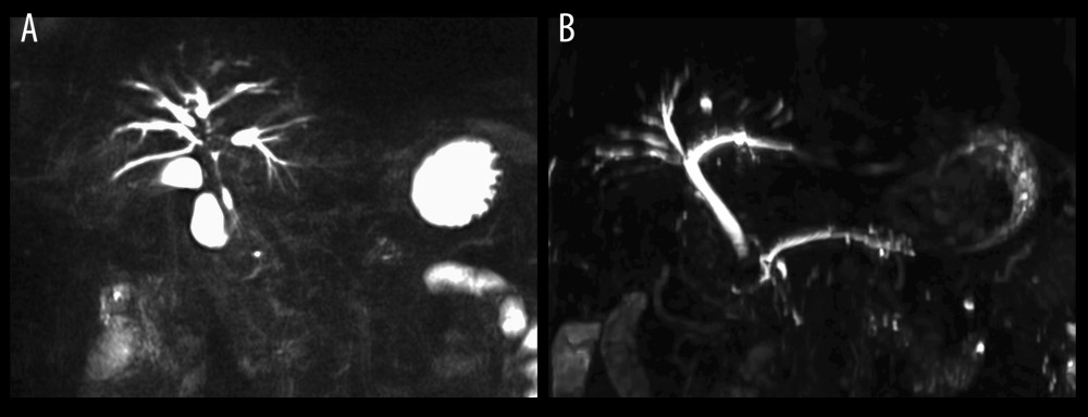 Magnetic resonance cholangiography (MRC) imaging findings. (A) MRC imaging during monotherapy with prednisolone (5 mg/d p. o.) demonstrating relapsed IgG4-SC. MRC findings indicate an occluded common bile duct. Next to this, intrahepatic bile ducts were dilated. (B) MRC during treatment with budesonide (9 mg/d p. o.) and low-dose 6-mercaptopurine (50 mg/d p. o.) demonstrating normal intra- and extrahepatic bile ducts without signs of IgG4-SC about 1 year after emergency cholecystectomy.