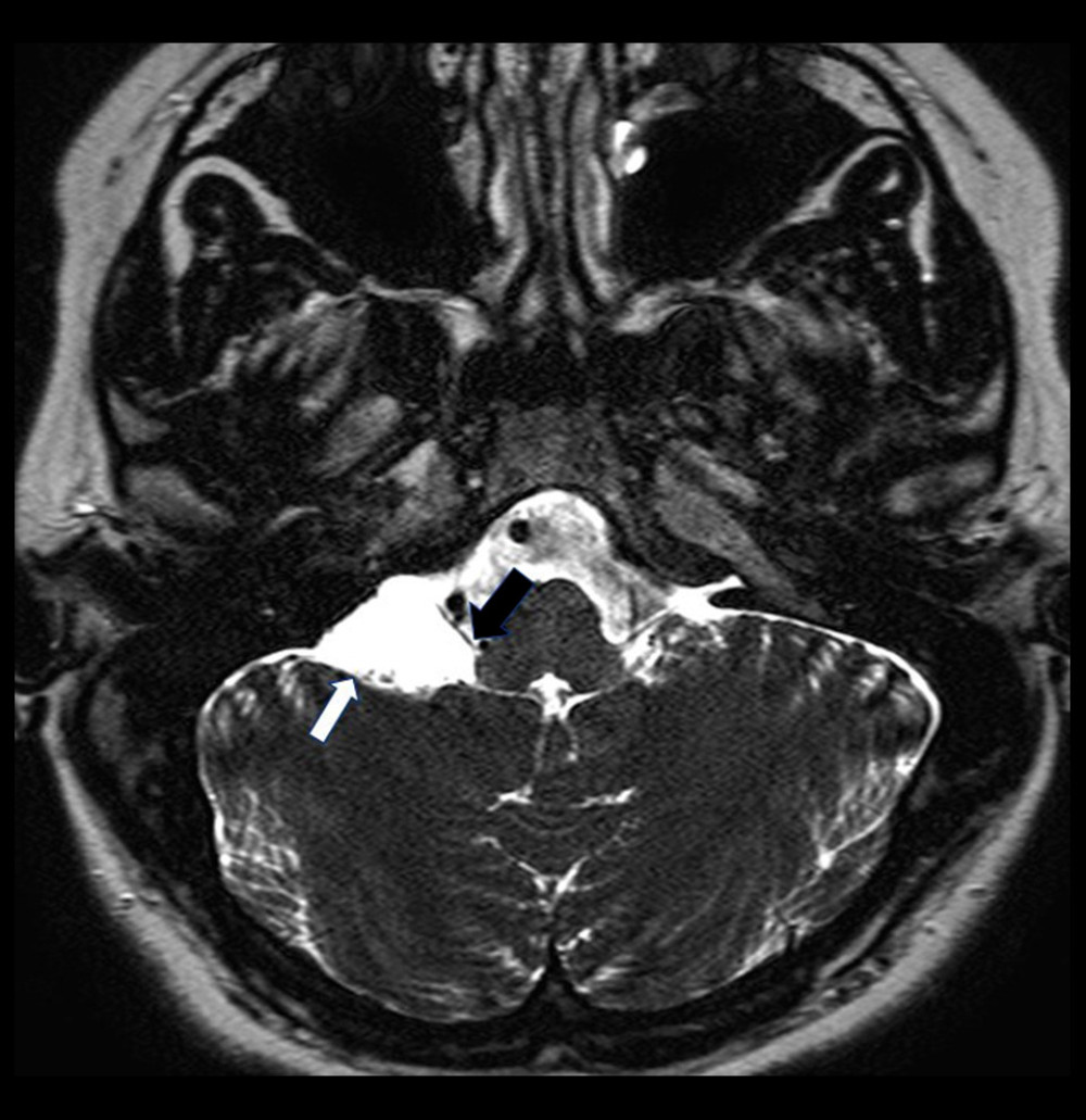 Magnetic resonance imaging demonstrating the right arachnoid cyst’s (white arrow) association with 7th and 8th cranial nerves (black arrow)