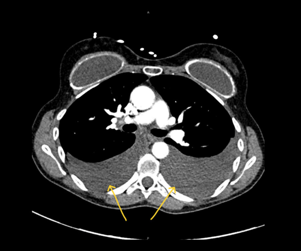 Computed tomography angiography (CTA) of the chest, demonstrating bilateral pleural effusions. Arrows indicate pleural effusions.
