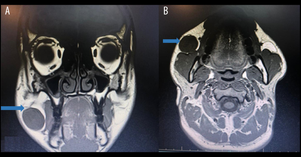 (A, B) Coronal and axial MRI show a well-defined lesion anterior to the masseter muscle (arrows).