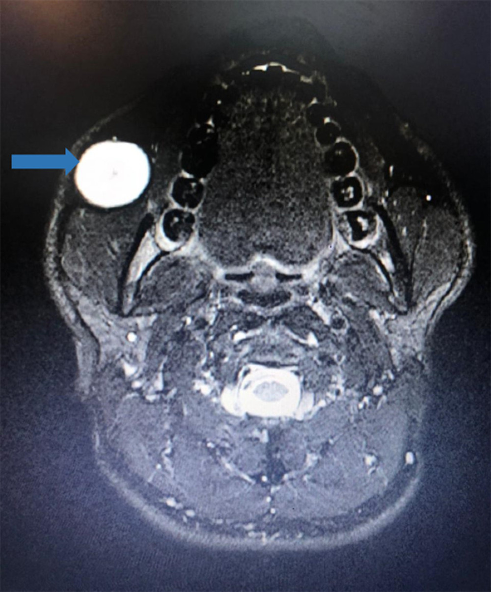 MRI shows a cystic lesion anterior to the right masseter muscle, measuring 28×24×20 mm (arrow). Hypointense in T1 and hyperintense in T2 with internal mini-cystic areas.